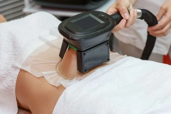 Image of person having fat freezing treatment to help weight gain Kings Hill