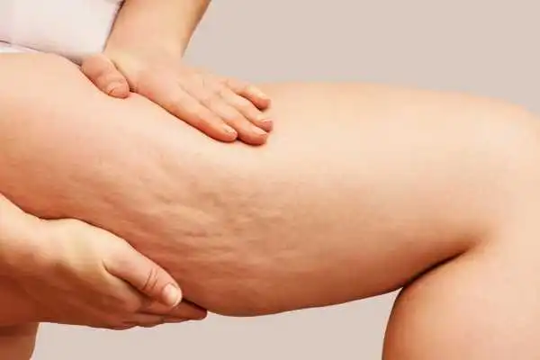 Image of woman showing leg with cellulite Kings Hill