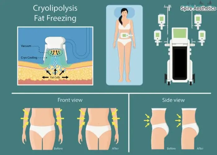 Fat freezing treatment Kings Hill benefits for competitions to remove stubborn fat deposits.