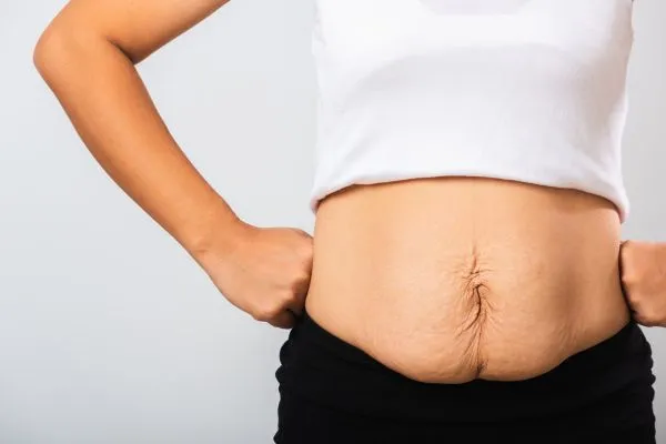 Image of a woman's stomach after weight loss with sagging skin following a gastric band Kings Hill